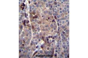 PRAMEF8 Antibody (C-term) immunohistochemistry analysis in formalin fixed and paraffin embedded human melanoma tissue followed by peroxidase conjugation of the secondary antibody and DAB staining. (PRAMEF8 抗体  (C-Term))
