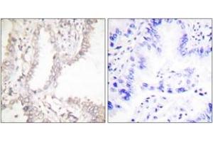 Immunohistochemistry analysis of paraffin-embedded human lung carcinoma tissue, using Prostate Apoptosis Response protein-4 Antibody. (PAWR 抗体  (AA 291-340))