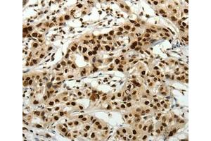 Immunohistochemical analysis of paraffin-embedded Human lung cancer tissue using at dilution 1/40.