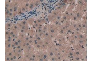 Detection of TNPO1 in Human Liver cancer Tissue using Polyclonal Antibody to Transportin 1 (TNPO1) (Transportin 1 抗体  (AA 626-836))