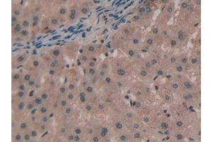 Detection of TNPO1 in Human Liver cancer Tissue using Polyclonal Antibody to Transportin 1 (TNPO1) (Transportin 1 抗体  (AA 626-836))