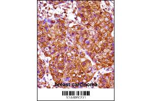 IRX3 Antibody immunohistochemistry analysis in formalin fixed and paraffin embedded human breast carcinoma followed by peroxidase conjugation of the secondary antibody and DAB staining. (IRX3 抗体  (N-Term))