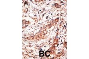 Formalin-fixed and paraffin-embedded human cancer tissue reacted with the primary antibody, which was peroxidase-conjugated to the secondary antibody, followed by DAB staining. (DOK4 抗体  (C-Term))