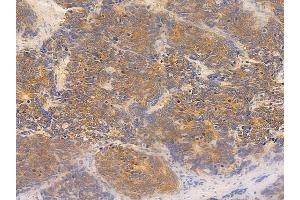 ABIN6259932 and ABIN6277014 at 1/100 staining human small cell lung carcinoma by IHC-P. (ANGPTL4 抗体  (N-Term))