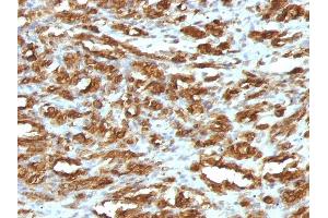 Formalin-fixed, paraffin-embedded human Rhabdomyosarcoma stained with Muscle Specific Actin Mouse Monoclonal Antibody (HHF35). (ACTA1/ACTA2A/ACTG2 抗体)