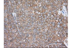 Immunohistochemical staining of paraffin-embedded Adenocarcinoma of Human colon tissue using anti-PDE4A mouse monoclonal antibody. (PDE4A 抗体)