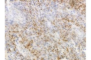 ABIN6263144 and ABIN6277139 at 1/100 staining human large cell lung carcinoma by IHC-P.