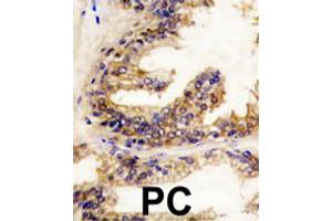 Formalin-fixed and paraffin-embedded human prostate carcinoma reacted with BRAF polyclonal antibody  , which was peroxidase-conjugated to the secondary antibody, followed by DAB staining. (BRAF 抗体  (Internal Region))