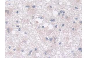Detection of MOSC1 in Human Glioma Tissue using Polyclonal Antibody to MOCO Sulphurase C-Terminal Domain Containing Protein 1 (MOSC1)