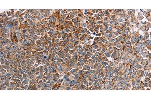 Immunohistochemistry of paraffin-embedded Human ovarian cancer tissue using PLXNA2 Polyclonal Antibody at dilution 1:40 (Plexin A2 抗体)