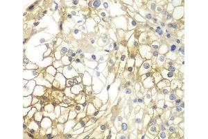 Immunohistochemistry of paraffin-embedded Human kidney cancer using Syndecan-1 Polyclonal Antibody at dilution of 1:200 (40x lens). (Syndecan 1 抗体)