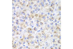 Immunohistochemistry of paraffin-embedded human liver cancer using HAO1 antibody. (HAO1 抗体)