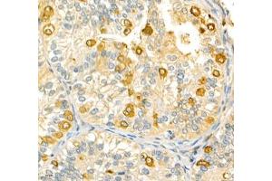 Immunohistochemistry of paraffin embedded human metrocarcinoma using ANXA3 (ABIN7073065) at dilution of 1: 200 (400x lens) (Annexin A3 抗体)
