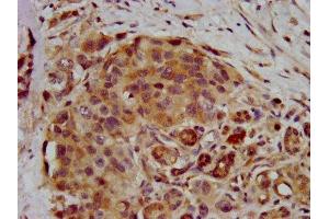 IHC image of ABIN7168260 diluted at 1:400 and staining in paraffin-embedded human pancreatic cancer performed on a Leica BondTM system. (RNF39 抗体  (AA 200-321))