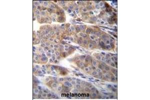 PLA2G2C Antibody (C-term) (ABIN655935 and ABIN2845327) immunohistochemistry analysis in formalin fixed and paraffin embedded human melanoma followed by peroxidase conjugation of the secondary antibody and DAB staining. (PLA2G2C 抗体  (C-Term))
