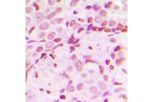 Immunohistochemical analysis of TCOF1 staining in human breast cancer formalin fixed paraffin embedded tissue section. (TCOF1 抗体  (N-Term))