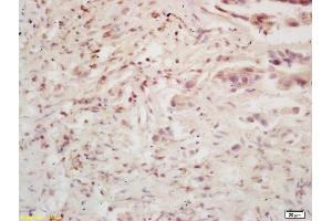 Formalin-fixed and paraffin embedded human colon carcinoma labeled with Rabbit Anti BMI1/PCGF4 Polyclonal Antibody, Unconjugated (ABIN682678) at 1:200 followed by conjugation to the secondary antibody and DAB staining (BMI1 抗体  (AA 61-160))