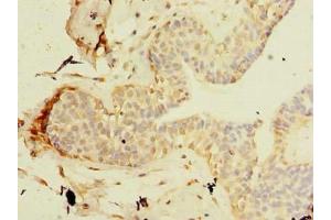 Immunohistochemistry of paraffin-embedded human breast cancer using ABIN7171449 at dilution of 1:100 (TCP11L2 抗体  (AA 1-210))