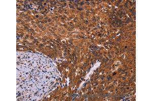 Immunohistochemistry of Human colon cancer using CDC5L Polyclonal Antibody at dilution of 1:40 (CDC5L 抗体)