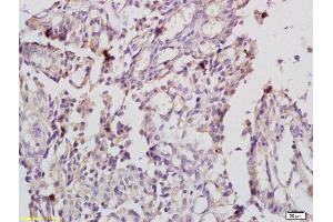 Formalin-fixed and paraffin embedded human endometrial cancer labeled with Anti-IL-20R alpha/IL20RA Polyclonal Antibody, Unconjugated (ABIN748103) at 1:200 followed by conjugation to the secondary antibody (IL20RA 抗体  (AA 135-171))