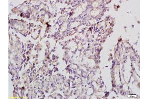 Formalin-fixed and paraffin embedded human endometrial cancer labeled with Anti-IL-20R alpha/IL20RA Polyclonal Antibody, Unconjugated (ABIN748103) at 1:200 followed by conjugation to the secondary antibody