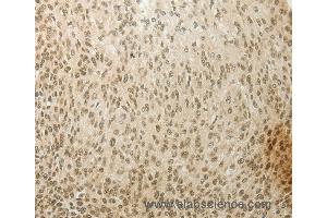Immunohistochemistry of Human cervical cancer using MYSM1 Polyclonal Antibody at dilution of 1:60