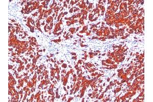 Formalin-fixed, paraffin-embedded human Breast Carcinoma stained with pan Cytokeratin Monoclonal Antibody cocktail (SPM115 + SPM116). (KRT77, KRT76 抗体)