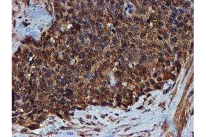 Immunohistochemical staining of paraffin-embedded Adenocarcinoma of Human breast tissue using anti-ENDOG mouse monoclonal antibody. (Endonuclease G 抗体)