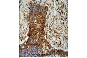 P2 antibody ABIN659015 iunohistochemistry analysis in formalin fixed and paraffin embedded human lung carcinoma followed by peroxidase conjμgation of the secondary antibody and DAB staining.