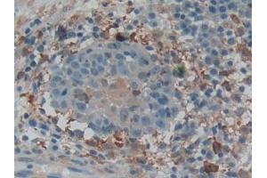 Detection of GSN in Human Skin cancer Tissue using Polyclonal Antibody to Gelsolin (GSN)