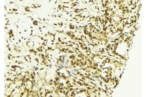 ABIN6269077 at 1/100 staining Human breast cancer tissue by IHC-P. (c-MYC 抗体  (N-Term))
