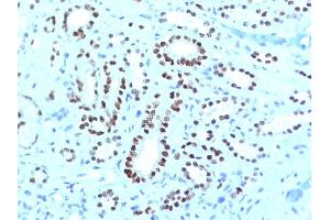 Formalin-fixed, paraffin-embedded human Renal Cell Carcinoma stained with PAX8 Monoclonal Antibody (PAX8/1491 + PAX8/1492). (PAX8 抗体)