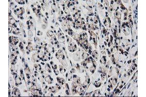 Immunohistochemical staining of paraffin-embedded Adenocarcinoma of Human colon tissue using anti-VCAM1 mouse monoclonal antibody.