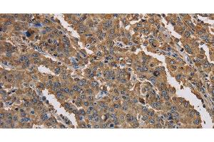 Immunohistochemistry of paraffin-embedded Human liver cancer tissue using KCNG1 Polyclonal Antibody at dilution 1:40 (KCNG1 抗体)