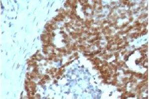Formalin-fixed, paraffin-embedded human ovarian carcinoma stained with Nucleolin antibody. (Nucleolin 抗体)