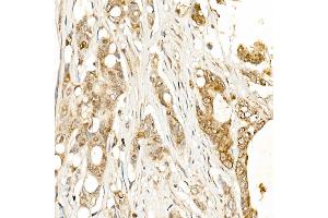 Immunohistochemistry of paraffin-embedded human colon carcinoma using KLK1 Rabbit pAb (ABIN3022581, ABIN3022582, ABIN3022583 and ABIN6218920) at dilution of 1:500 (40x lens).