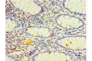 Immunohistochemistry of paraffin-embedded human colon cancer using ABIN7149272 at dilution of 1:100 (CYP4F12 抗体  (AA 265-524))