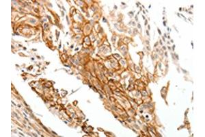 The image on the left is immunohistochemistry of paraffin-embedded Human cervical cancer tissue using ABIN7192777(TGM1 Antibody) at dilution 1/25, on the right is treated with synthetic peptide. (TGM1 抗体)