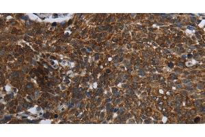 Immunohistochemistry of paraffin-embedded Human cervical cancer using FASTKD2 Polyclonal Antibody at dilution of 1:45 (FASTKD2 抗体)