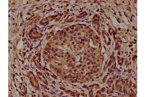IHC image of ABIN7143354 diluted at 1:200 and staining in paraffin-embedded human pancreatic cancer performed on a Leica BondTM system. (CAP1 抗体  (AA 22-157))