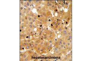 PRKAA1 Antibody IHC analysis in formalin fixed and paraffin embedded human hepatocarcinoma followed by peroxidase conjugation of the secondary antibody and DAB staining. (PRKAA1 抗体)