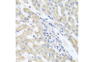 Immunohistochemistry of paraffin-embedded human liver injury using ITPKB antibody at dilution of 1:100 (x40 lens). (ITPKB 抗体)