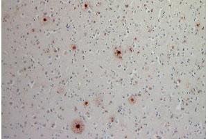 Indirect immunostaining of a PFA fixed, formic acid trated paraffin embedded cortex section from a sporadic Alzheimer´s disease patient (dilution 1 : 200). (Abeta 1-42 抗体)
