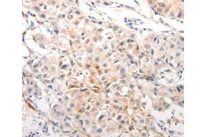 Immunohistochemical analysis of paraffin-embedded Human breast cancer tissue using. (Keratin 6B 抗体  (Internal Region))