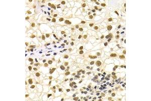 Immunohistochemistry of paraffin-embedded human kidney cancer using DDB1 Antibody. (DDB1 抗体)