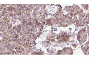 ABIN6273263 at 1/100 staining Human pancreas cancer tissue by IHC-P. (EIF2D 抗体  (Internal Region))