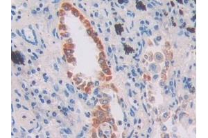 Detection of IFI16 in Human Lung cancer Tissue using Polyclonal Antibody to Interferon Gamma Inducible Protein 16 (IFI16) (IFI16 抗体  (AA 465-671))