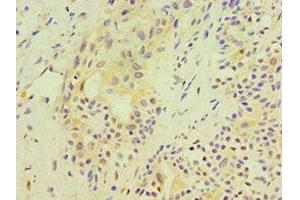 Immunohistochemistry of paraffin-embedded human breast cancer using ABIN7170540 at dilution of 1:100 (Spermidine Synthase 抗体  (AA 1-302))