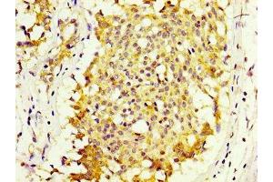 IHC image of ABIN7151059 diluted at 1:600 and staining in paraffin-embedded human breast cancer performed on a Leica BondTM system. (MKRN1 抗体  (AA 109-209))