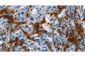 Immunohistochemistry of paraffin-embedded Human lung cancer tissue using IL20RA Polyclonal Antibody at dilution 1:35 (IL20RA 抗体)